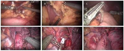 Robot-assisted Ivor Lewis Esophagectomy (RAILE): A review of surgical techniques and clinical outcomes